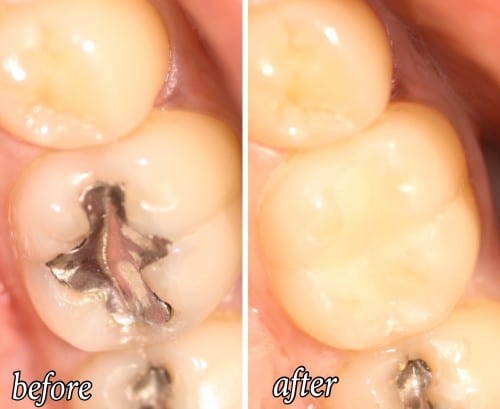 Before and after of a Streitz Dental Arts patient — Silver Filling Replaced with White Filling