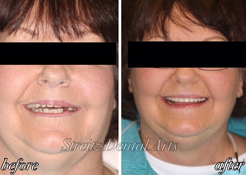 Before and after of a Streitz Dental Arts patient — New Smile Restored with a Denture