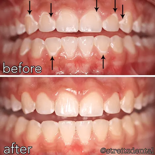 Before and after of a Streitz Dental Arts patient — White Spot Restoration with Cosmetic Bonding