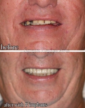Before and after of a Streitz Dental Arts patient — Dental Implants with Denture