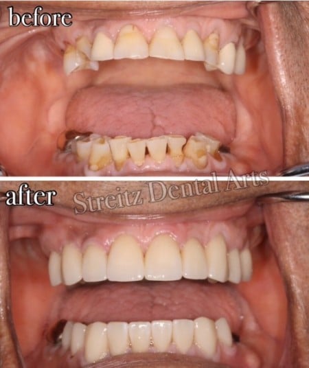 Before and after of a Streitz Dental Arts patient — Severe Wear Corrected with All-Porcelain Crowns