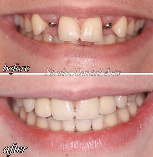 Before and after of a Streitz Dental Arts patient — Dental Implants