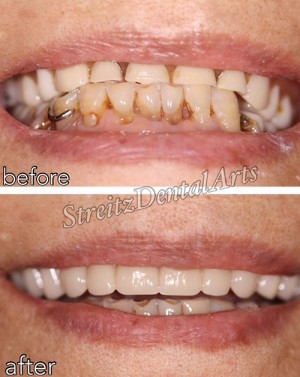 Before and after of a Streitz Dental Arts patient — Dentures
