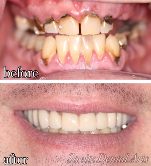 Before and after of a Streitz Dental Arts patient — Complete Smile Restoration — Implants & Porcelain Crowns