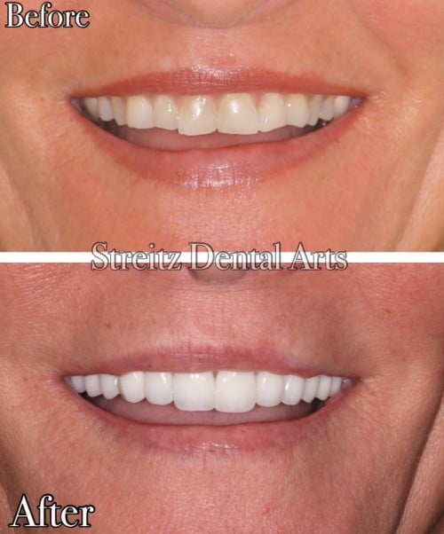 Before and after of a Streitz Dental Arts patient — Porcelain Crown Smile Makeover