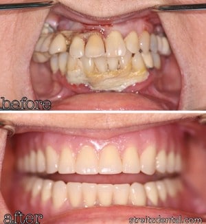Before and after of a Streitz Dental Arts patient — Upper and Lower Dentures