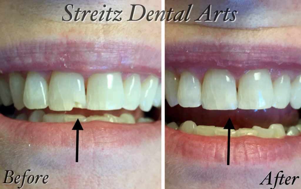 Before and after of a Streitz Dental Arts patient — Chipped Front Tooth — Composite Bonding